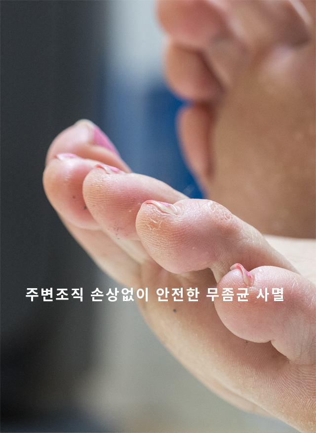 손발톱무좀