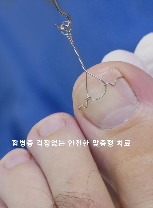 내향성발톱